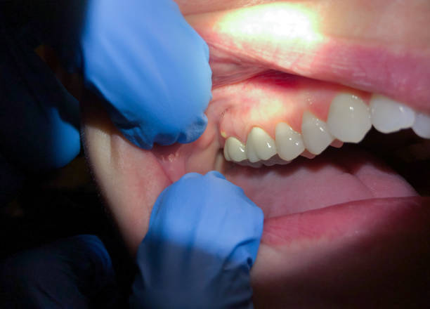 Best Cracked Tooth Emergency Dentist  in Lake View, AL